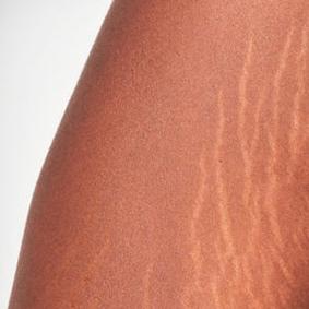 Scar and Stretchmark packages 