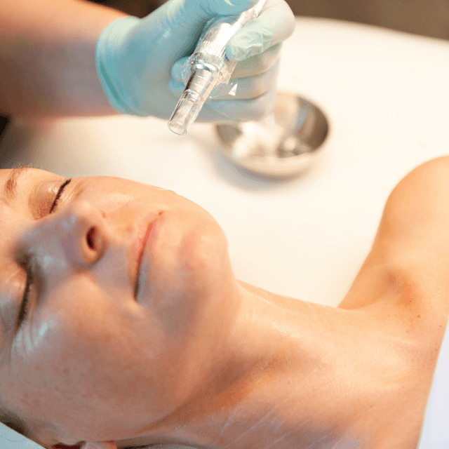 3 Microneedling + Treatment Package